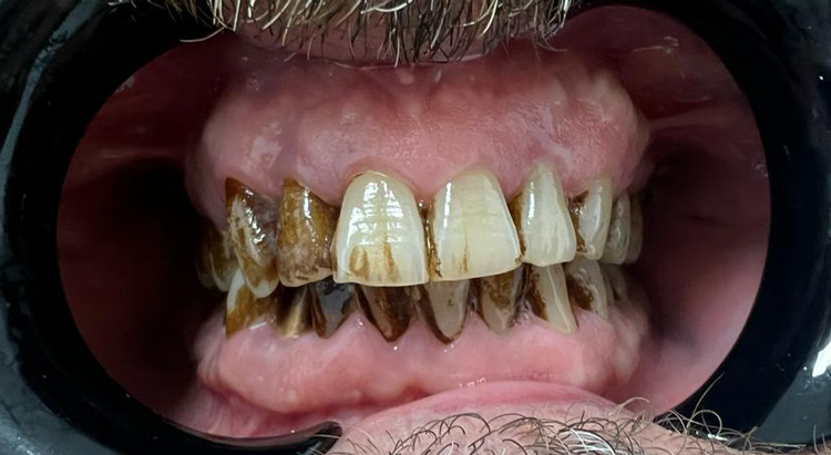caso manchas dentales abuso clorhexidina antes