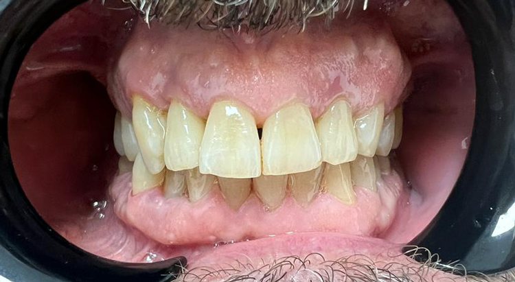 caso manchas dentales abuso clorhexidina despues