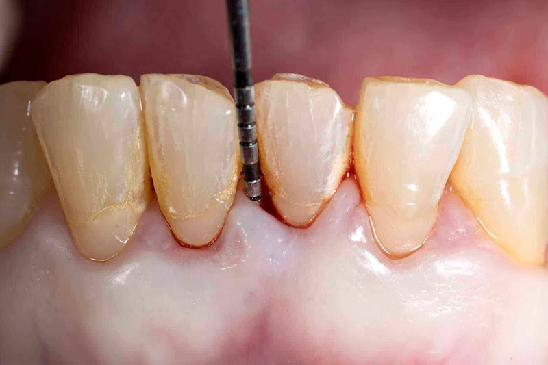 dientes con periodoncia